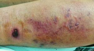 Nekrotizirajući fasciitis (bakterija koja jede meso): Što trebate znati?