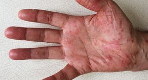 Palmoplantarna psorijaza: Zahvaća malu površinu kože, ali može ozbiljno otežati svakodnevni život