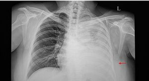 Voda u plućima ili pleuralni izljev: Što se događa u tijelu kad se tekućina počne nakupljati?