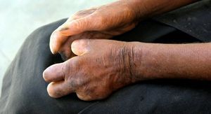 Ruke pacijenta oboljelog od gube