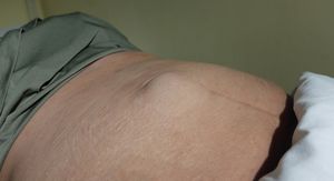 Bruh nakon operacije žuči: Kako ga prepoznati na vrijeme i izbjeći novu operaciju?