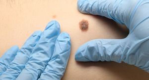 Ova navika gotovo utrostručuje rizik od najsmrtonosnijeg raka kože!