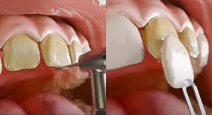 Animirana simulacija postavljanja ljuskica za zube