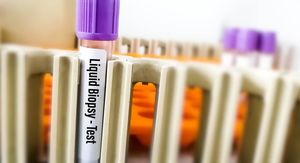 Tekuća biopsija: Jednostavna pretraga koja može otkriti rak bez invazivnih zahvata