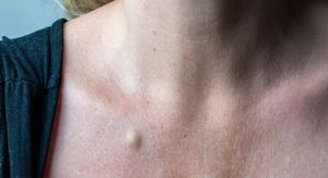 Ciste na koži: Zašto nastaju i kada ih je potrebno ukloniti?