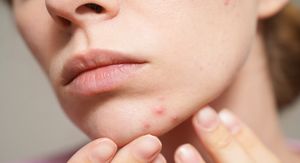 Uzrokuje li zatvor prištiće? Evo što dermatolozi žele da znate