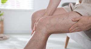 Vježbe za proširene vene koje poboljšavaju cirkulaciju brže nego što mislite
