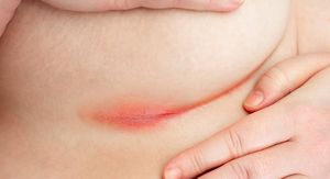 Inverzna psorijaza: Crvene, sjajne promjene na intimnim dijelovima koji mnogi zamijene za gljivice