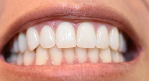 Raspored zubi kod čovjeka: Koliko odrasli čovjek ima zubi i kako ih stomatolozi dijele po brojevima?