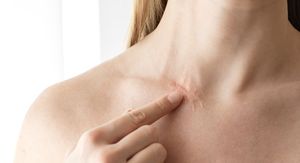 Svrbe vas ožiljci? Evo zašto se to događa i kako to konačno ublažiti