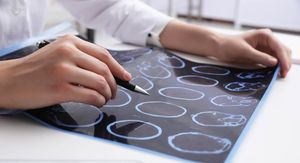 Dodatak prehrani koji se izdaje bez recepta mogao bi pomoći u liječenju multiple skleroze!