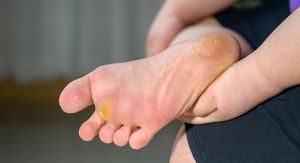 5 razloga zašto vam je koža na tabanima žuta (i kada morate što prije liječniku)