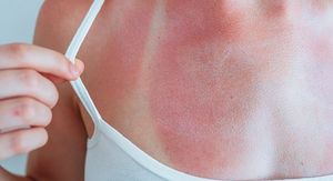 5 namirnica koje pomažu vašem tijelu da se oporavi od opeklina od sunca