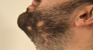 Alopecija brade: Zašto nastaje i može li se dlaka ponovno vratiti?