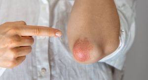 3 popodnevne navike koje mogu utjecati na vaš san ako imate psorijazu