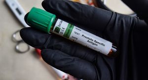 Novi test za rak prostate otkriva više opasnih slučajeva od PSA testa