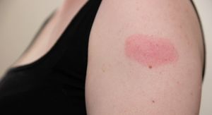 Atopijski dermatitis i cijepljenje: Kada je sigurno, a kada ga treba odgoditi?