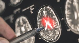 Umjetna inteligencija otkriva nešto što magnetska rezonanca dosad nije mogla uočiti!