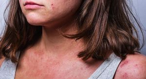 Atopijski dermatitis: Kako ga liječiti kod beba, djece i odraslih?