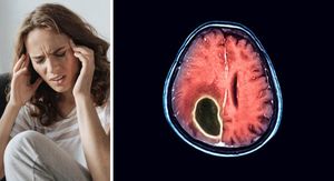 Dobroćudni tumor na mozgu: Izraz može zavarati jer mogu biti opasni po život! Liječnik otkriva vrste, simptome i mogućnosti liječenja