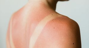Zašto neki ljudi izgore na suncu već nakon 15 minuta, a drugi ne?