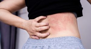 13 stvari koje mogu izazvati pogoršanje atopijskog dermatitisa