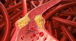 9 stvari koje morate znati ako imate povišen kolesterol