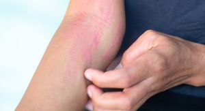 Ako vam se koprivnjača stalno vraća, moguće je da imate ovo stanje kože!