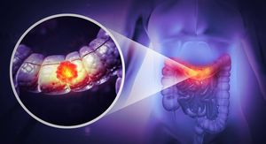 Liječnici sve češće viđaju mlađe pacijente s rakom debelog crijeva – zašto se to događa?