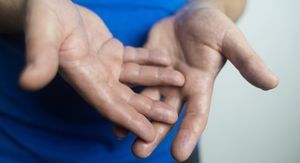 Znojenje (hiperhidroza) dlanova: Zašto se događa i kako ga smanjiti ili zaustaviti?