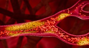 10 rizičnih pogrešaka vezanih uz kolesterol koje trebate izbjegavati ako imate više od 50 godina