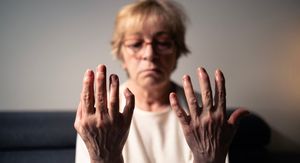 Reumatoidni artritis i životni vijek: 5 opasnih komplikacija koje mogu biti kobne