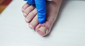 Retronihija: Problem s noktima koji češće pogađa žene