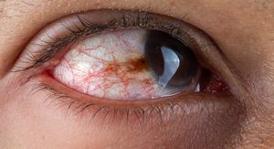 Herpes u oku: Opasnost za vid koju mnogi ignoriraju