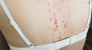 Mehaničke akne: Ove akne nemaju veze s hormonima – evo što ih zapravo uzrokuje i kako se liječe