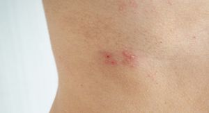 Herpes zoster prijeti ovim ljudima: Jeste li među rizičnim skupinama?