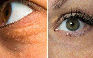 Ksantelazma ili masne naslage oko očiju: Nisu opasne, ali upućuju na ozbiljnije probleme sa zdravljem! Evo kako ih ukloniti | Kreni zdravo!
