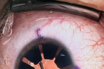 Implantacija umjetne šarenice u KBC Split