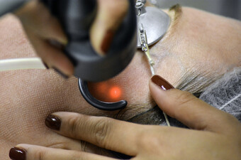 Laserski tretman, ilustracija