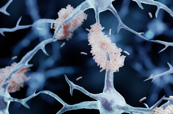 Amiloidni plakovi na neuronima u mozgu, ilustracija