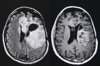 Tumor na mozgu, ilustracija