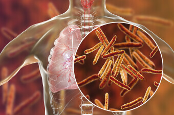 Tuberkuloza, ilustracija