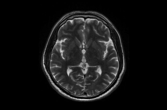 MRI mozga, ilustracija