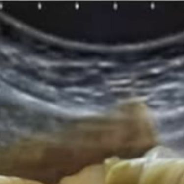 Snimka ultrazvuka sa sarmom u želucu