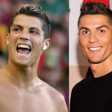 Cristiano Ronaldo prije i nakon što je sredio zube