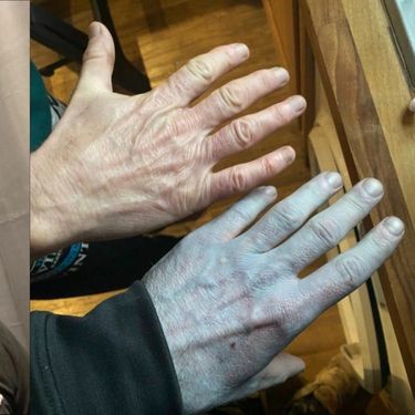 Tommy Lynch i njegovo bizarno plavo stanje