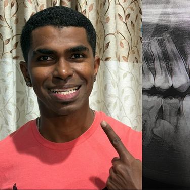 Muškarac iz Malezije Prathab Muniandy i njegovi rekordni zubi