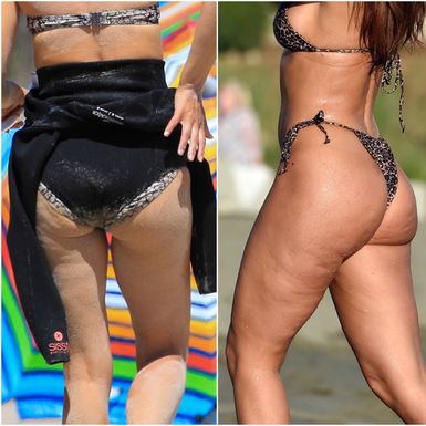 Celulit imaju i najljepše žene svijeta