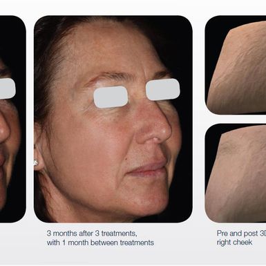 Prije i poslije tretmana laserom LUMENIS M22