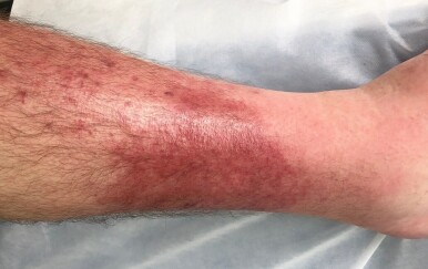 Celulitis: Simptomi koje mnogi ignoriraju – a mogu dovesti do ozbiljnih komplikacija